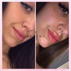 Lip plumper